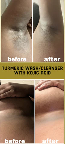 Turmeric Cleanser & Wash with Kojic Acid